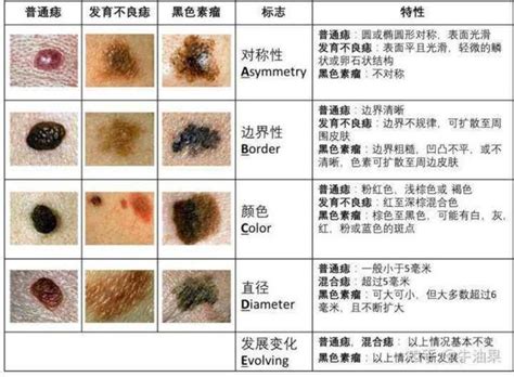 痣種類|痣是什麼？會變成黑色素瘤？7種一定要除的痣